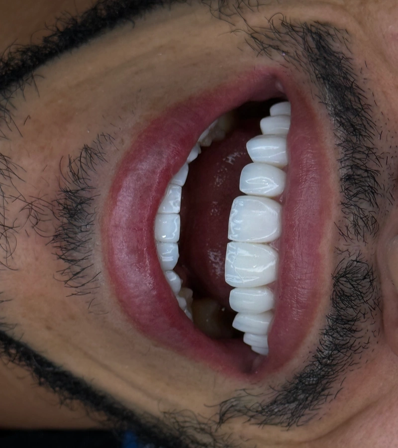 Altara-Beauty-Smile-proceso-1