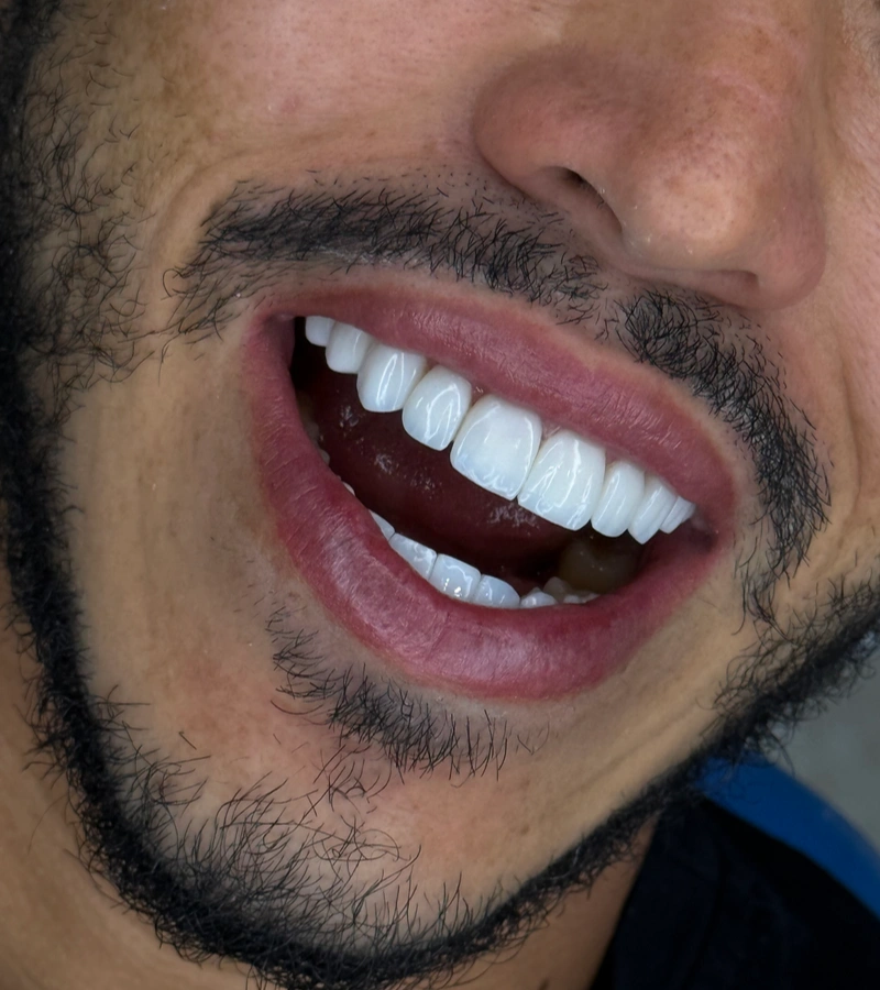 Altara-Beauty-Smile-proceso-2