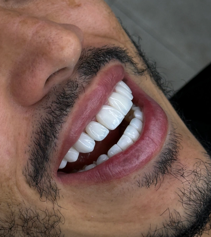 Altara-Beauty-Smile-proceso-3