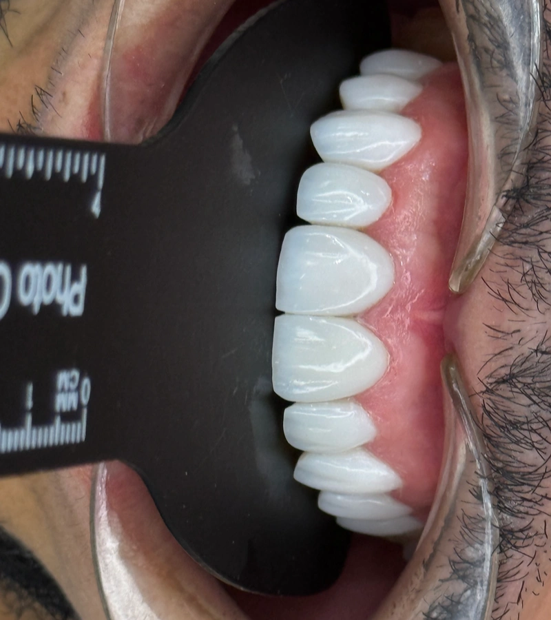 Altara-Beauty-Smile-proceso-4