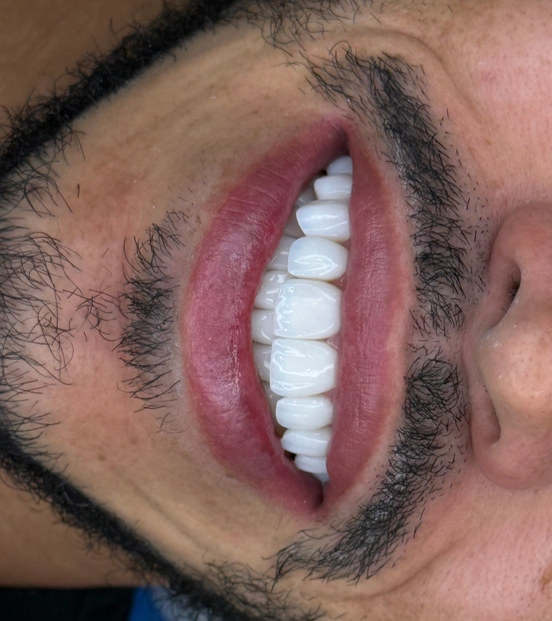 Altara-Beauty-Smile-proceso-5