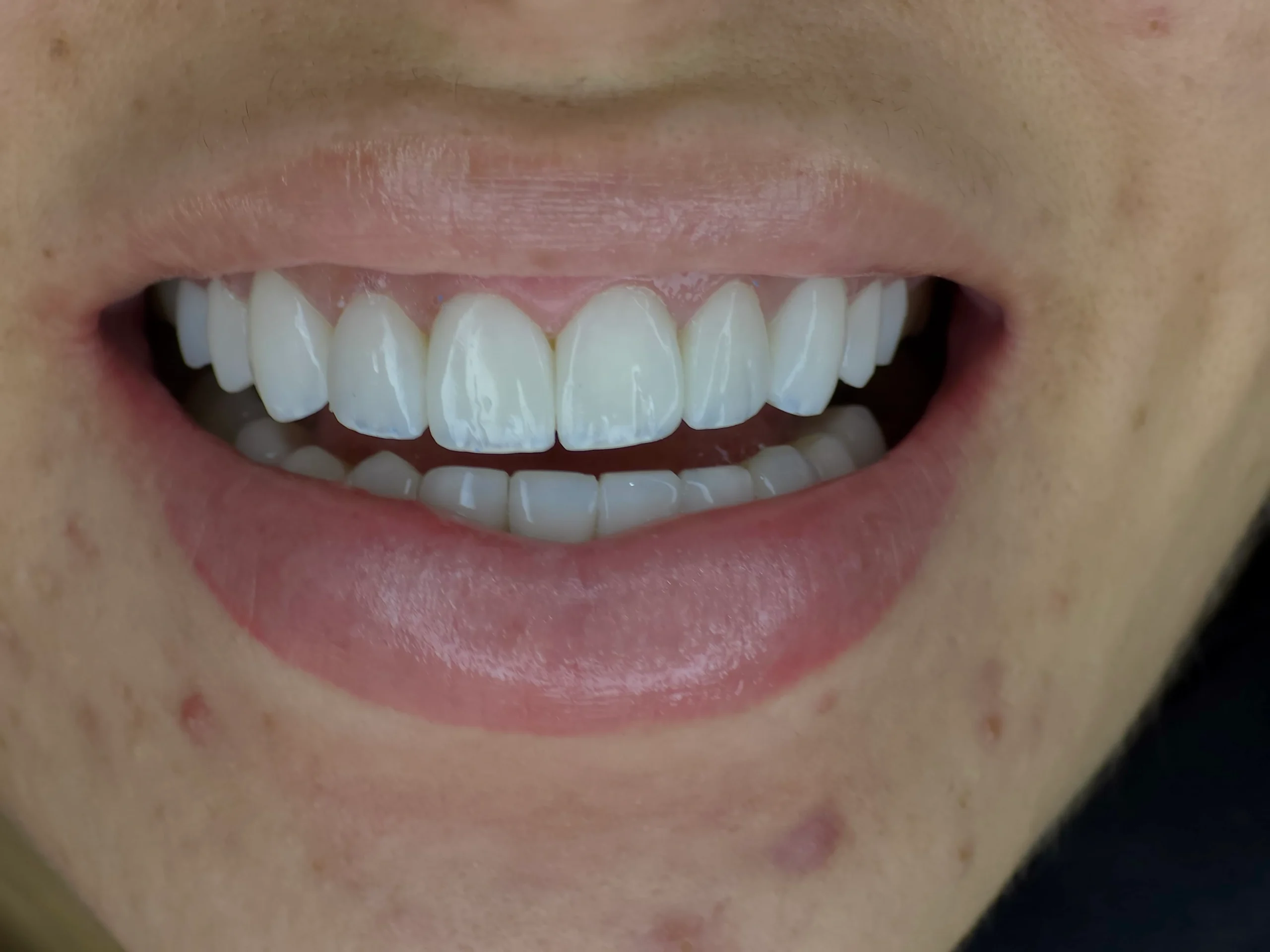 Altara-Beauty-Smile-sonrisa-1