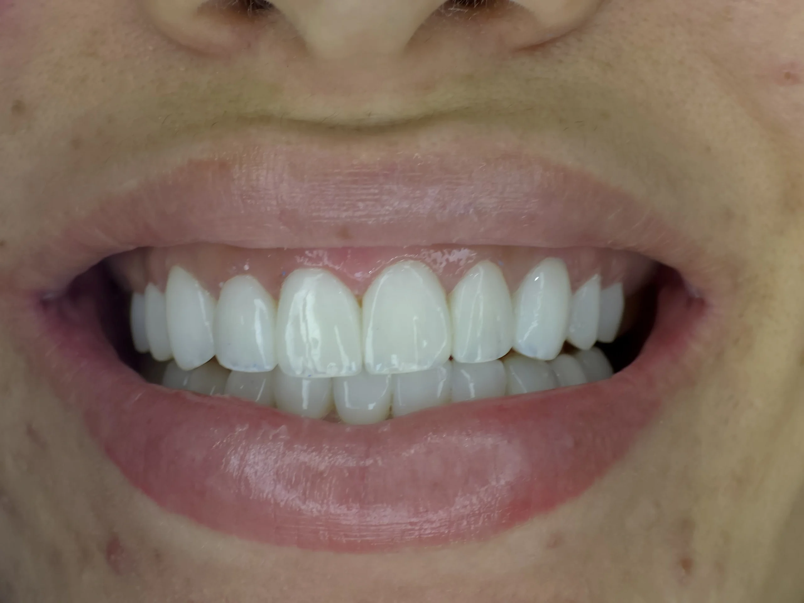 Altara-Beauty-Smile-sonrisa-2